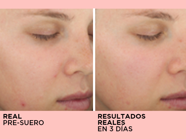 anticaida